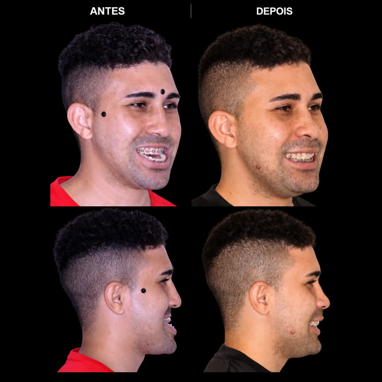 Antes e depois de cirurgia ortognática no Rio de Janeiro — Correção de mordida e harmonização do sorriso. Fotos pré e pós-operatórias de paciente do Dr. Guilherme Lima, cirurgião bucomaxilofacial.