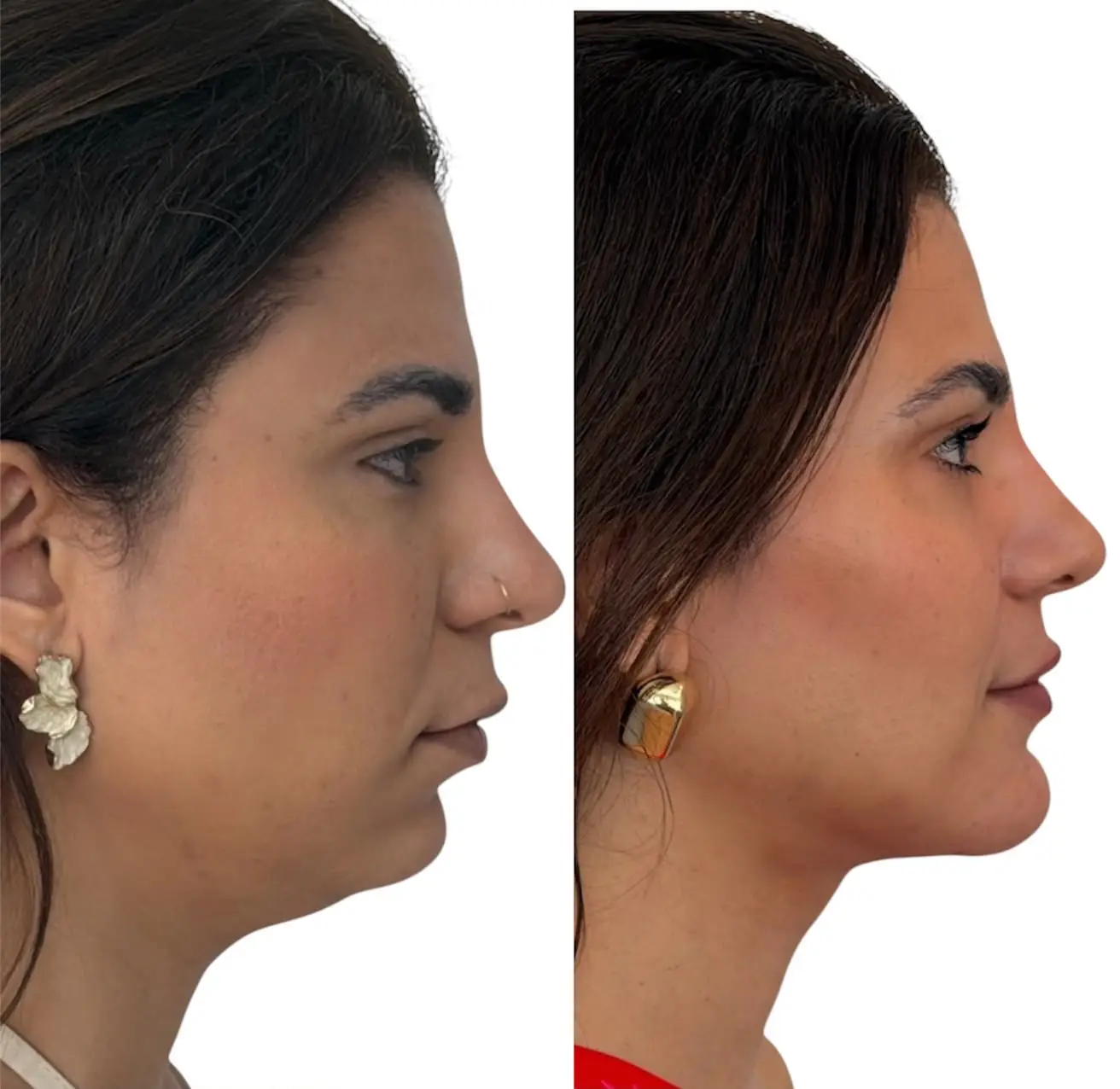 Perfil pré e pós-operatório de mentoplastia associada a cervicoplastia