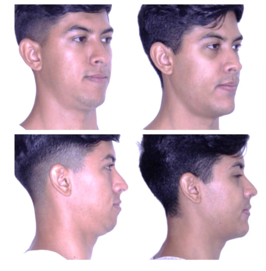 Antes e depois de cirurgia ortognática no Rio de Janeiro — Correção de retrognatismo com definição do contorno mandibular. Fotos pré e pós-operatórias de paciente do Dr. Guilherme Lima, cirurgião bucomaxilofacial.
