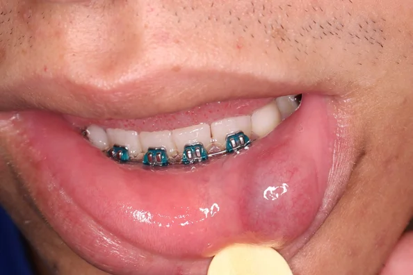 Mucocele, aumento de volume arredondado e arroxeado no lábio inferior