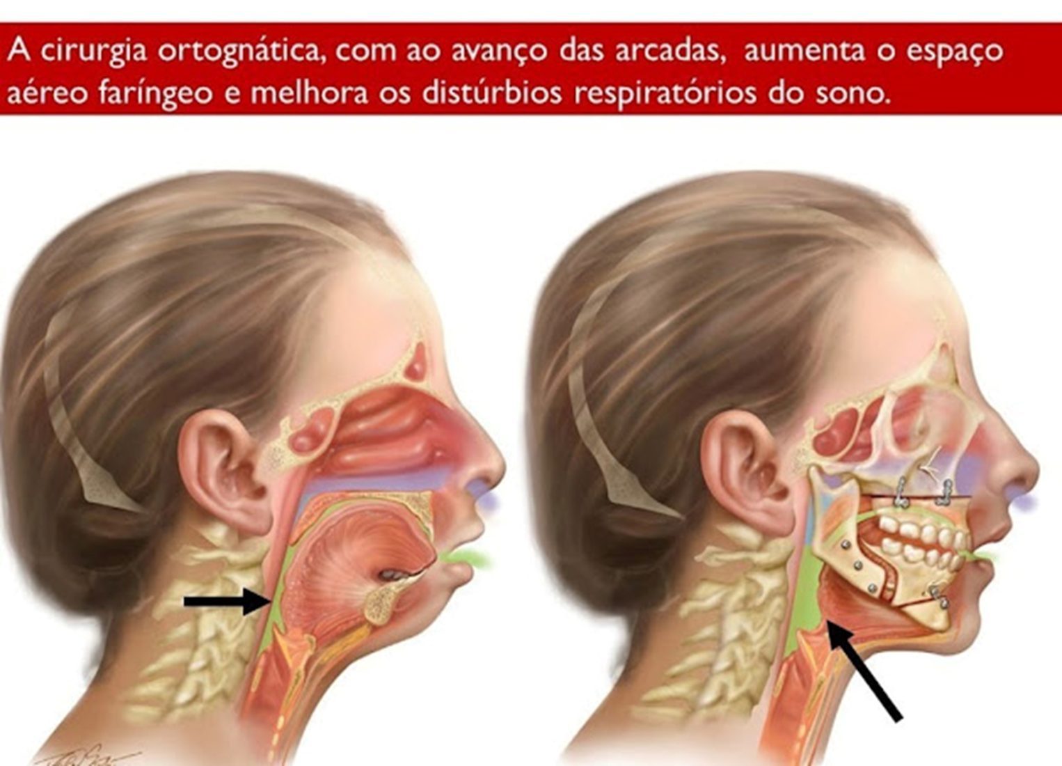 Ilustração comparativa: antes e depois da cirurgia ortognática mostrando ampliação do espaço aéreo faríngeo