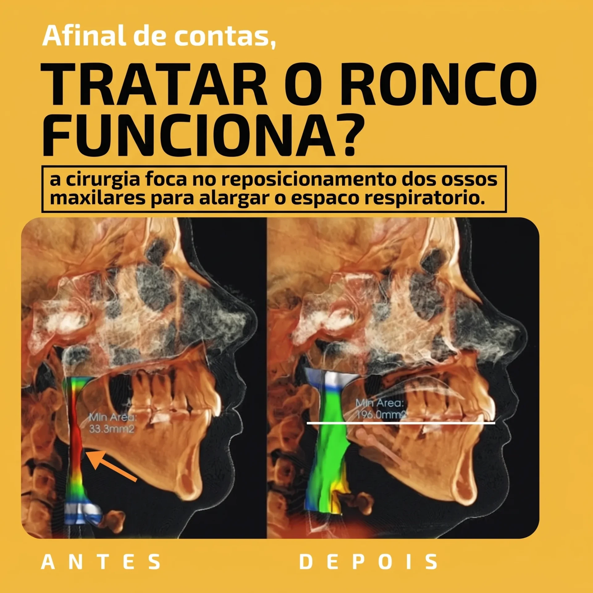 Animação 3D do avanço maxilomandibular: reposicionamento da maxila e da mandíbula para ampliar a via aérea