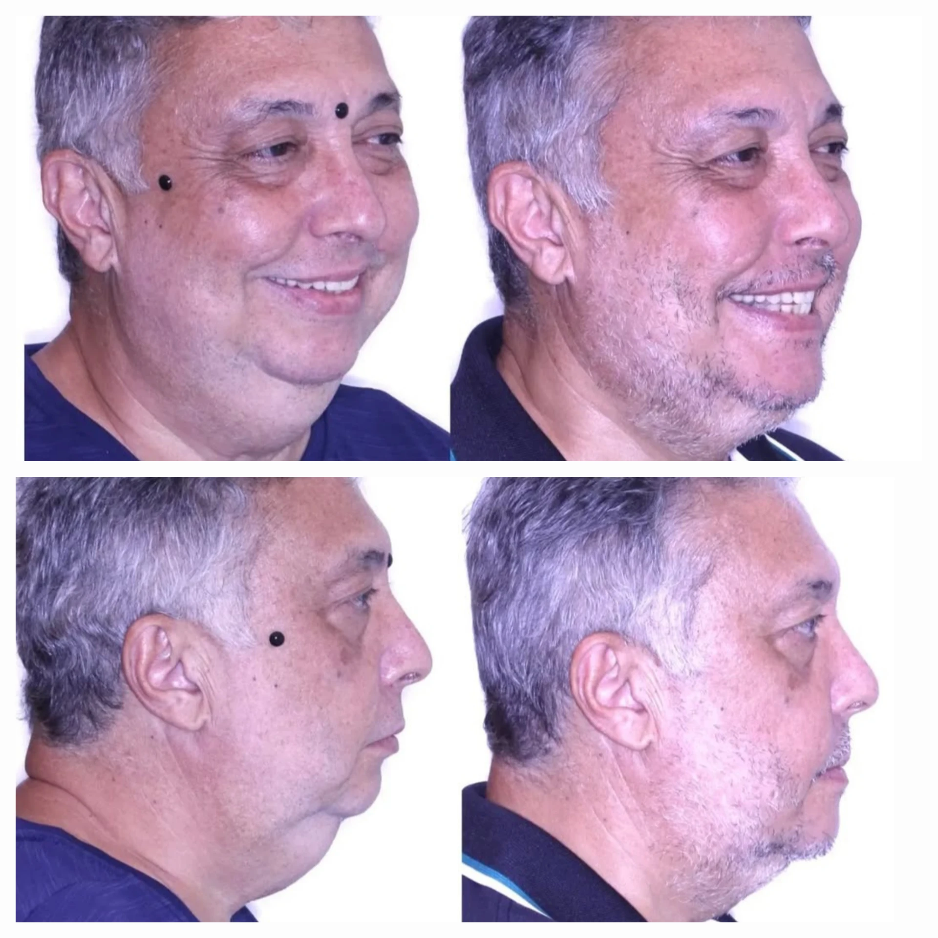Antes e depois de cirurgia ortognática no Rio de Janeiro — Correção do perfil em paciente adulto — vistas de perfil e três quartos. Fotos pré e pós-operatórias de paciente do Dr. Guilherme Lima, cirurgião bucomaxilofacial.