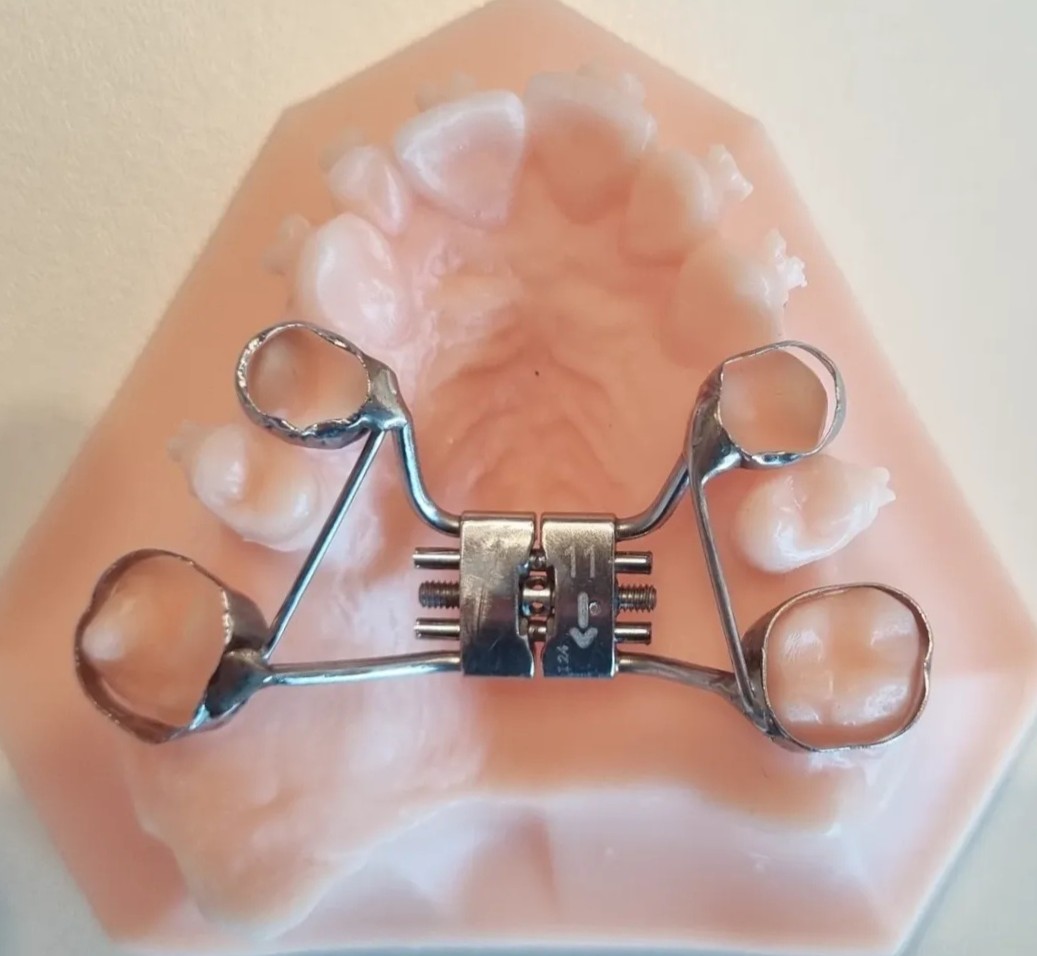 Expansor do tipo Hyrax adaptado em modelo de gesso da arcada superior, com bandas nos molares e pré-molares e parafuso expansor central