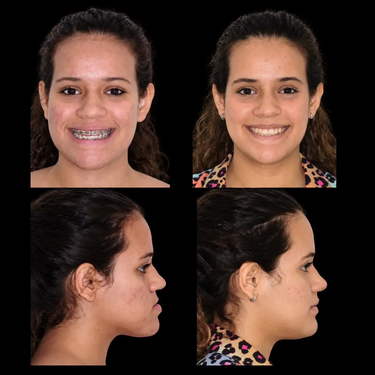 Paciente jovem em vistas frontal e de perfil, antes e depois do tratamento ortodôntico-cirúrgico.