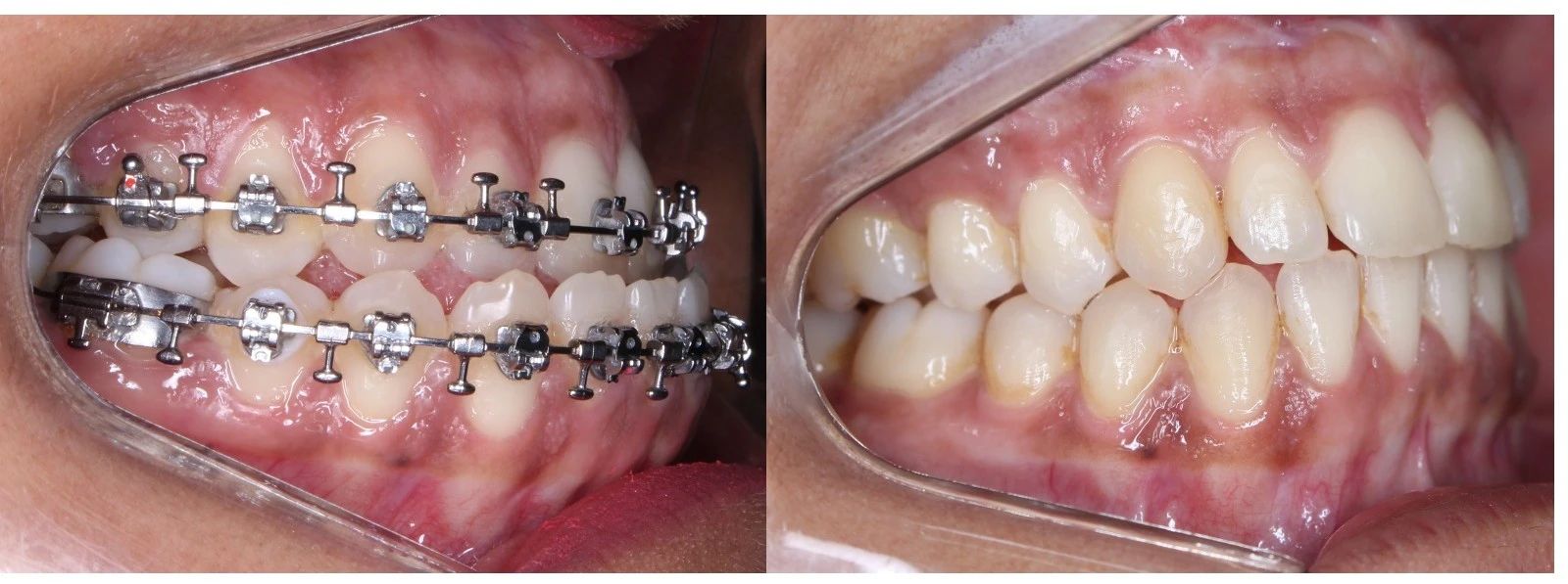 Registro intraoral em vista lateral de caso Classe III: à esquerda, mordida pré-operatória com aparelho ortodôntico; à direita, oclusão estável após cirurgia ortognática.