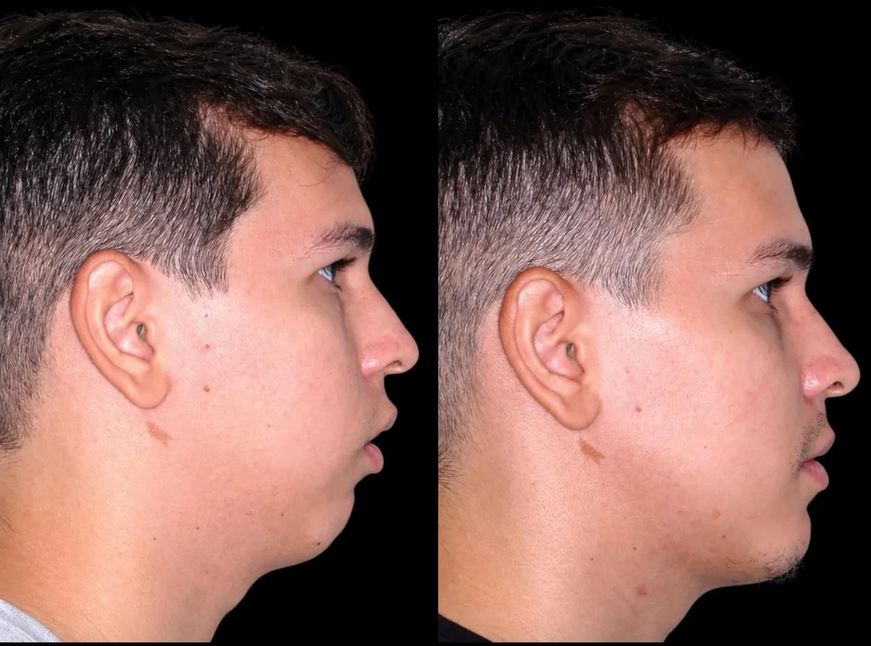 Caso clínico de retrognatismo: vistas de perfil e três quartos antes, com queixo recuado e contorno cervical pouco definido, e depois da cirurgia ortognática com avanço mandibular
