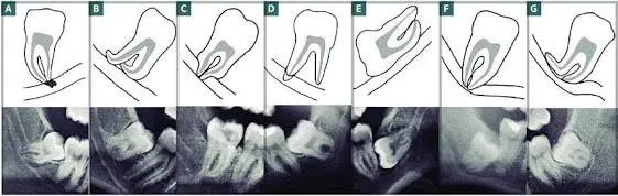 Desenhos e radiografias de sisos inferiores em diferentes angulações e relações com o canal mandibular