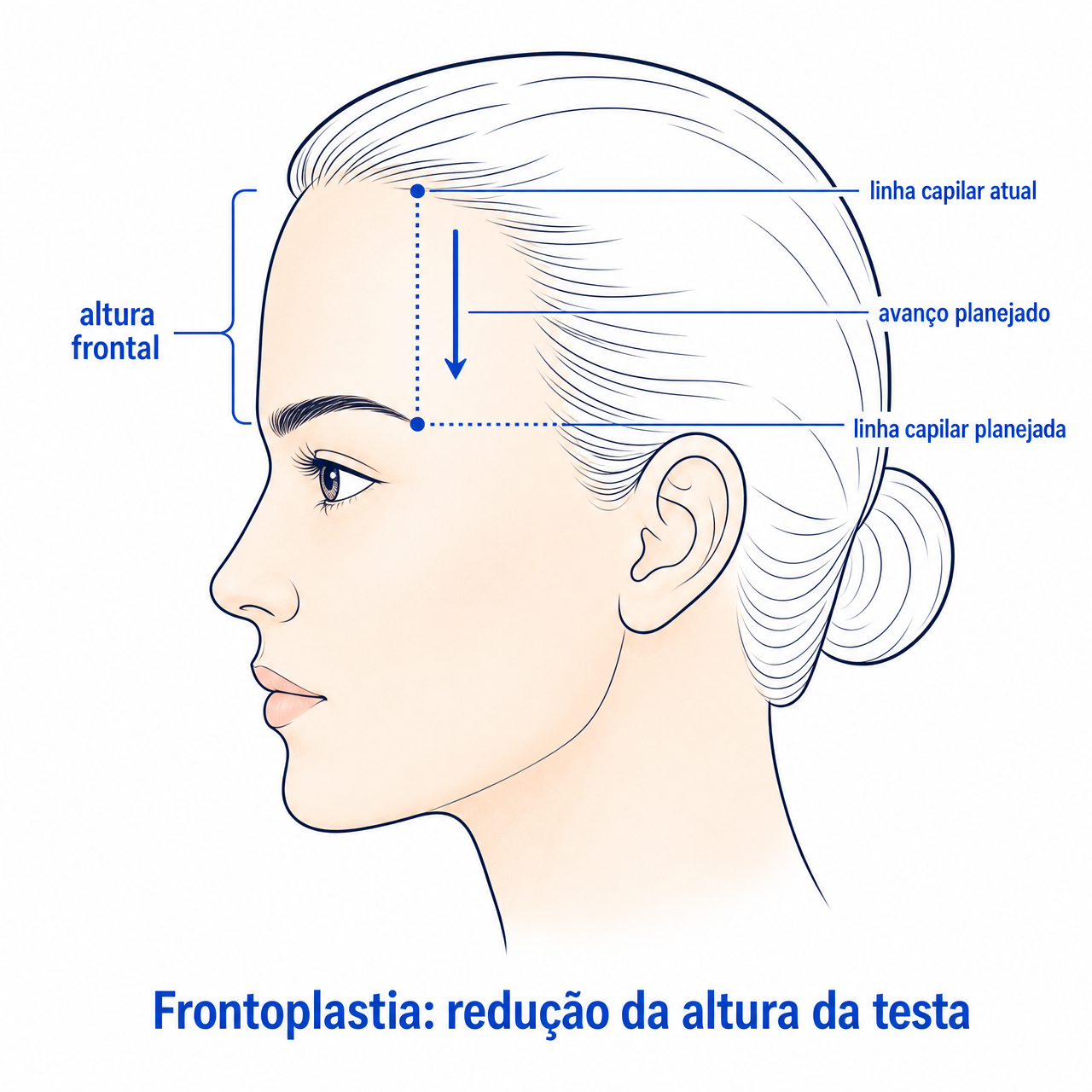 Ilustração da frontoplastia para redução da testa e avanço da linha do cabelo