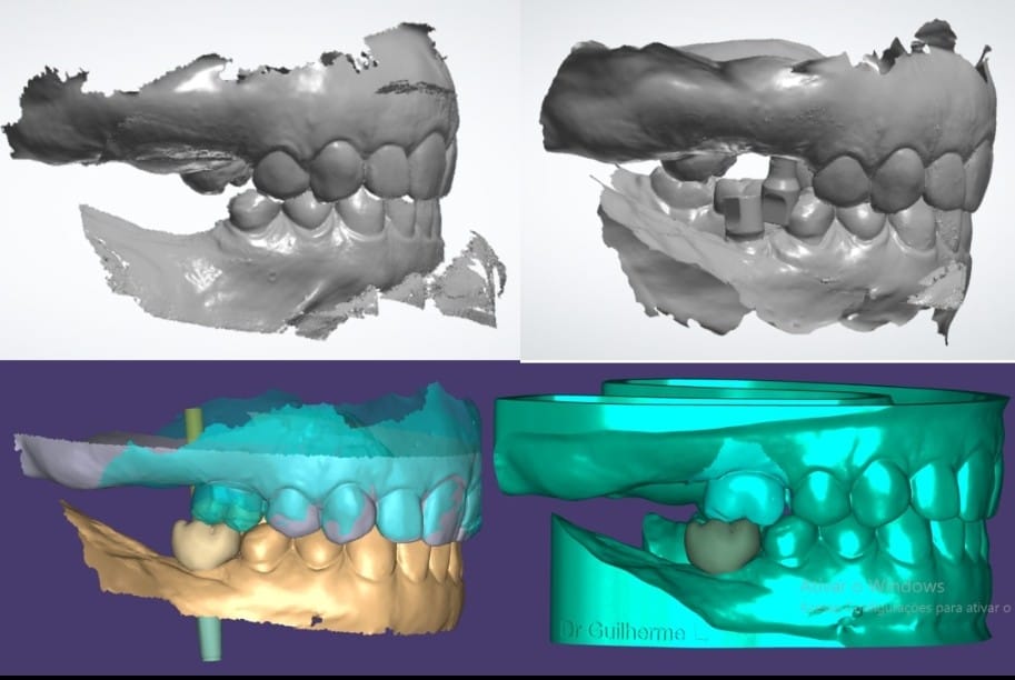 Escaneamento intraoral digital e prótese virtual sobre implante