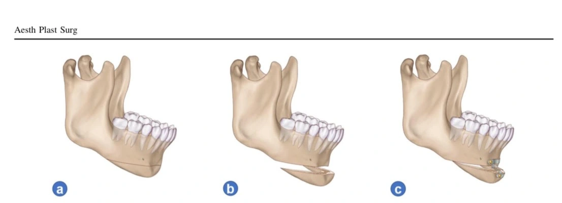 Esquema científico das etapas da osteotomia horizontal do mento: marcação, corte ósseo e reposicionamento fixado com placa