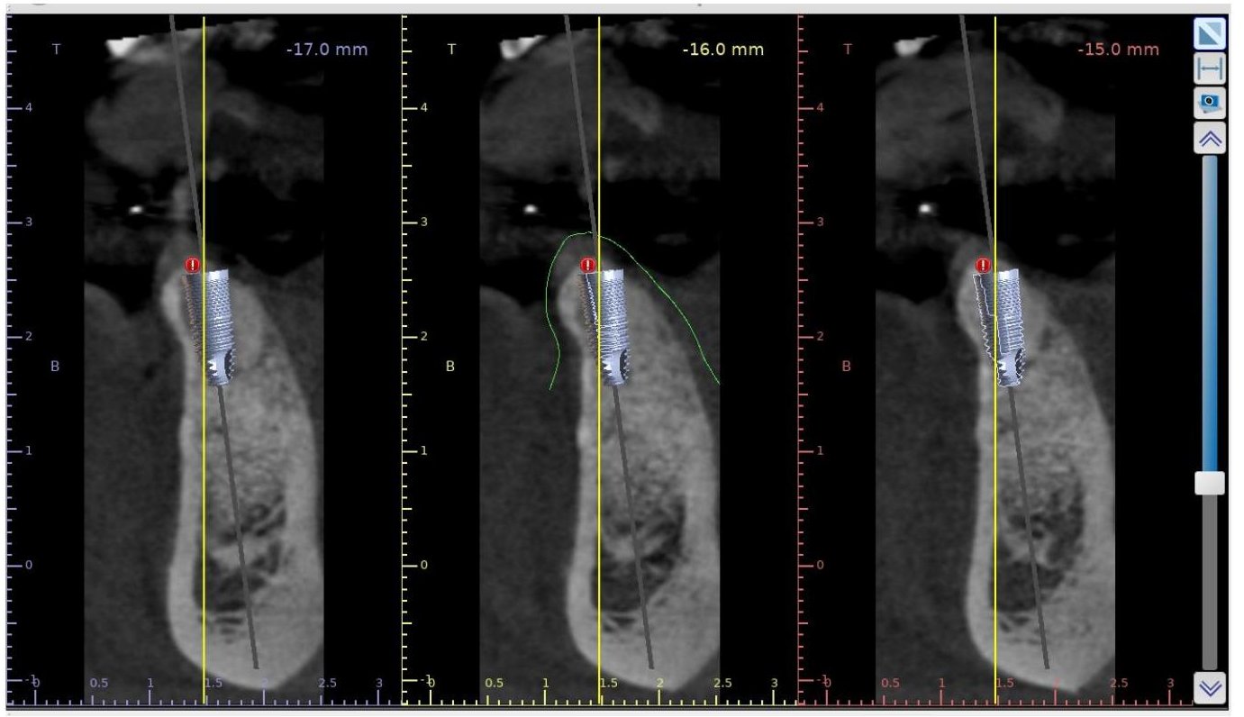 Cortes tomográficos com implante posicionado virtualmente no osso