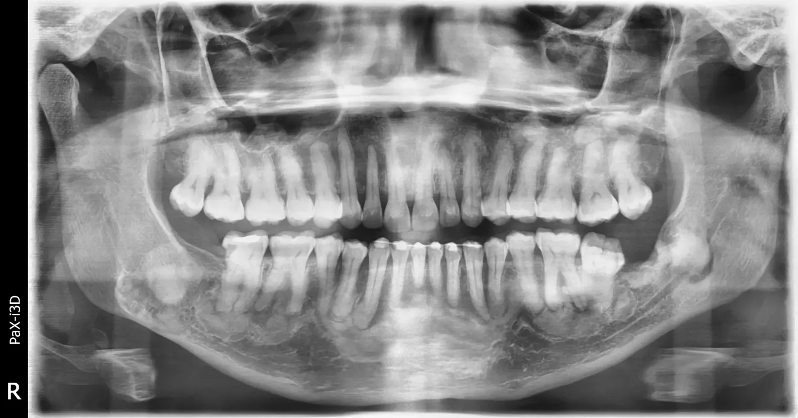 Radiografia panorâmica com áreas de osso alterado em ambos os lados da mandíbula, em caso de displasia fibrosa poliostótica