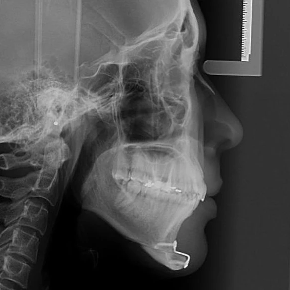 Telerradiografia lateral pós-operatória de mentoplastia, mostrando o avanço do mento fixado com miniplacas e parafusos