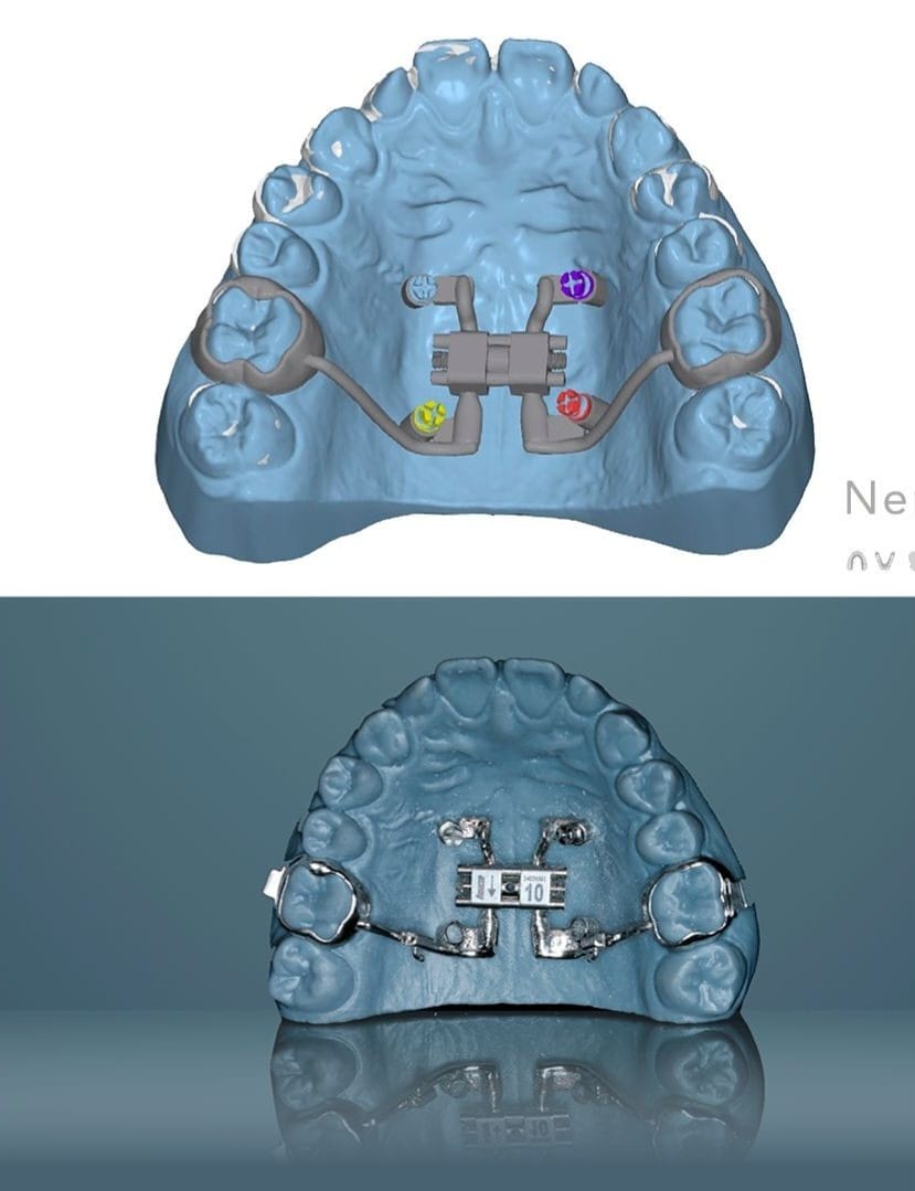 Planejamento digital 3D de expansor maxilar ancorado em mini-implantes sobre modelo virtual da arcada superior e, abaixo, o aparelho confeccionado no modelo