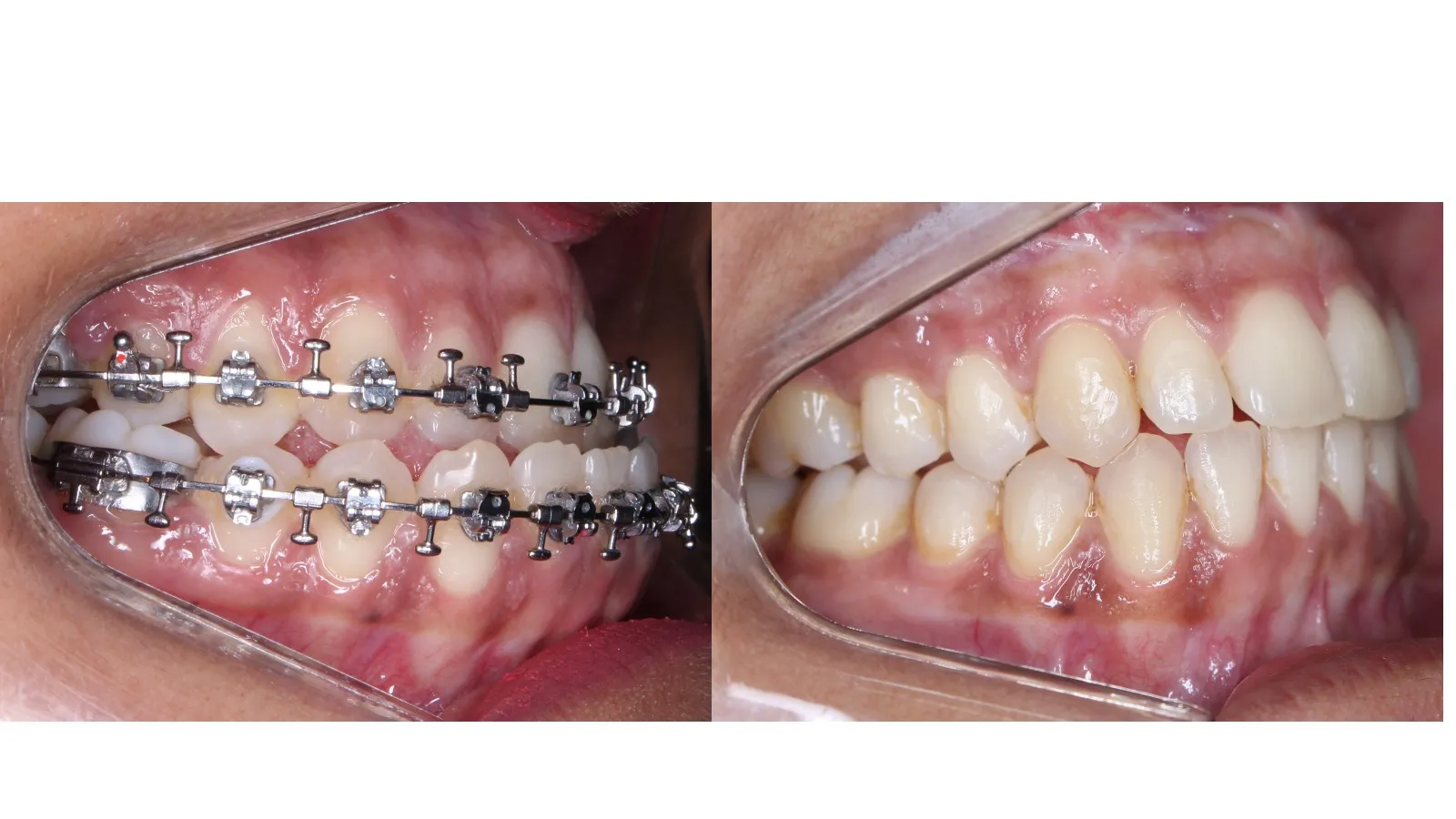 Vista lateral intraoral de mordida cruzada anterior de Classe III com aparelho fixo antes do tratamento e oclusão corrigida após a cirurgia ortognática