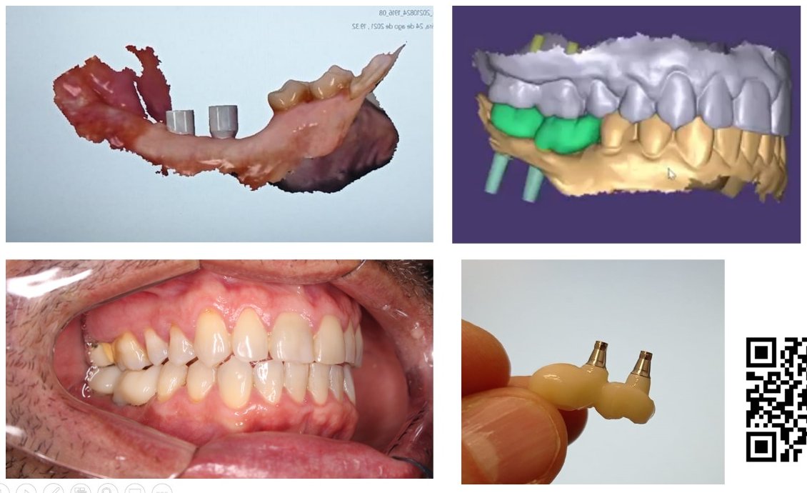 Fluxo digital: escaneamento, desenho da prótese, prótese sobre implantes e resultado na boca
