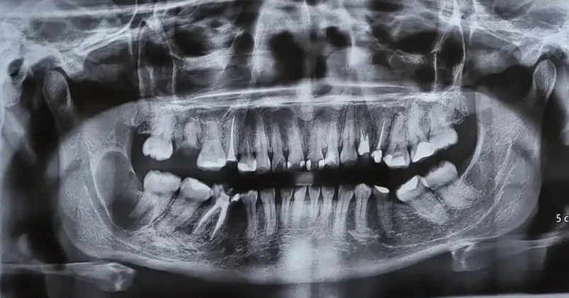Radiografia panorâmica com área alterada na mandíbula