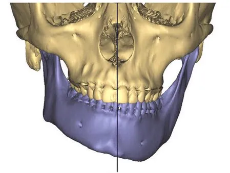 Modelo 3D demonstrando assimetria facial: comparação dos dois lados da mandíbula