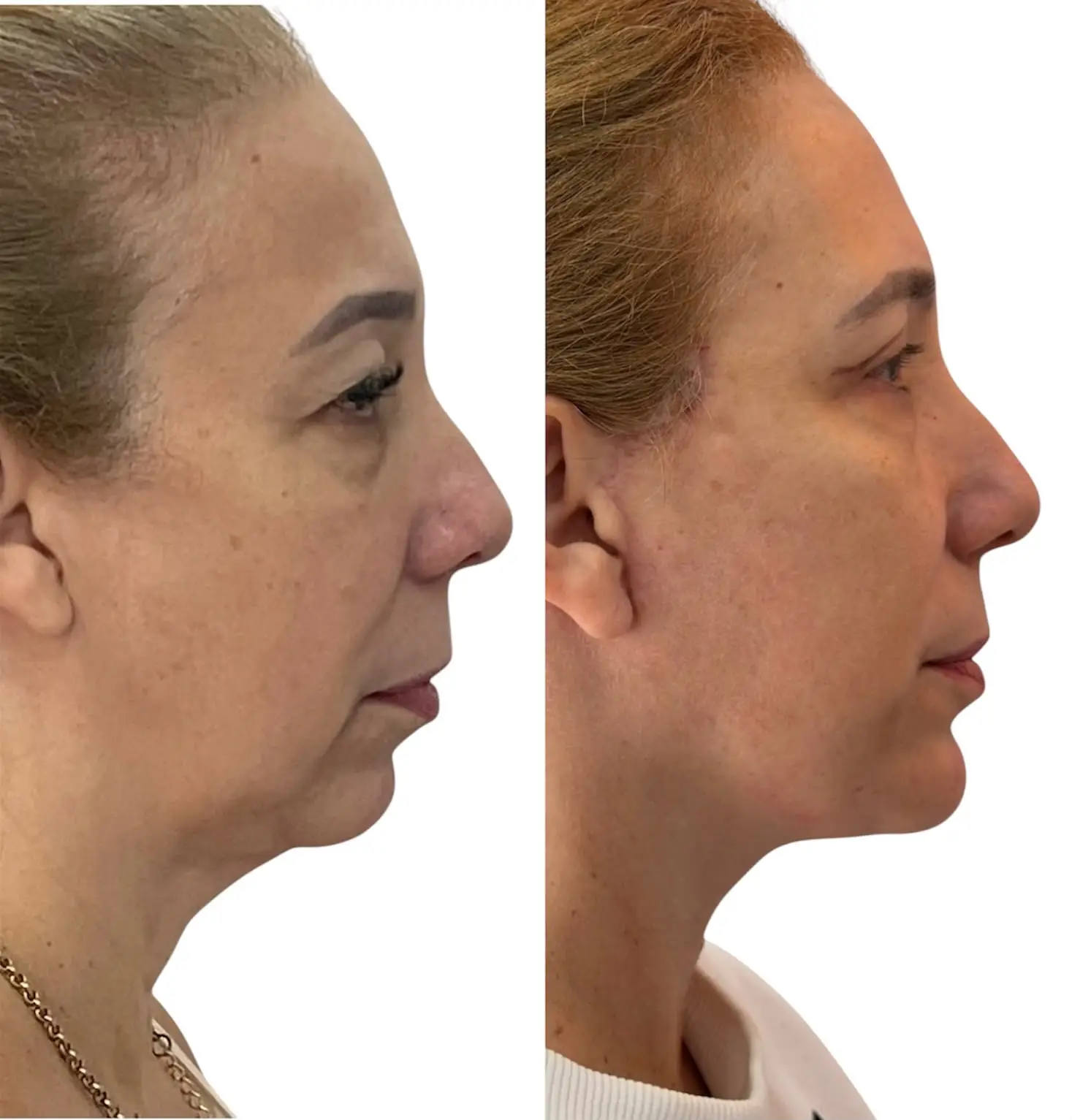 Perfil pré e pós-operatório de facelift associado a mentoplastia