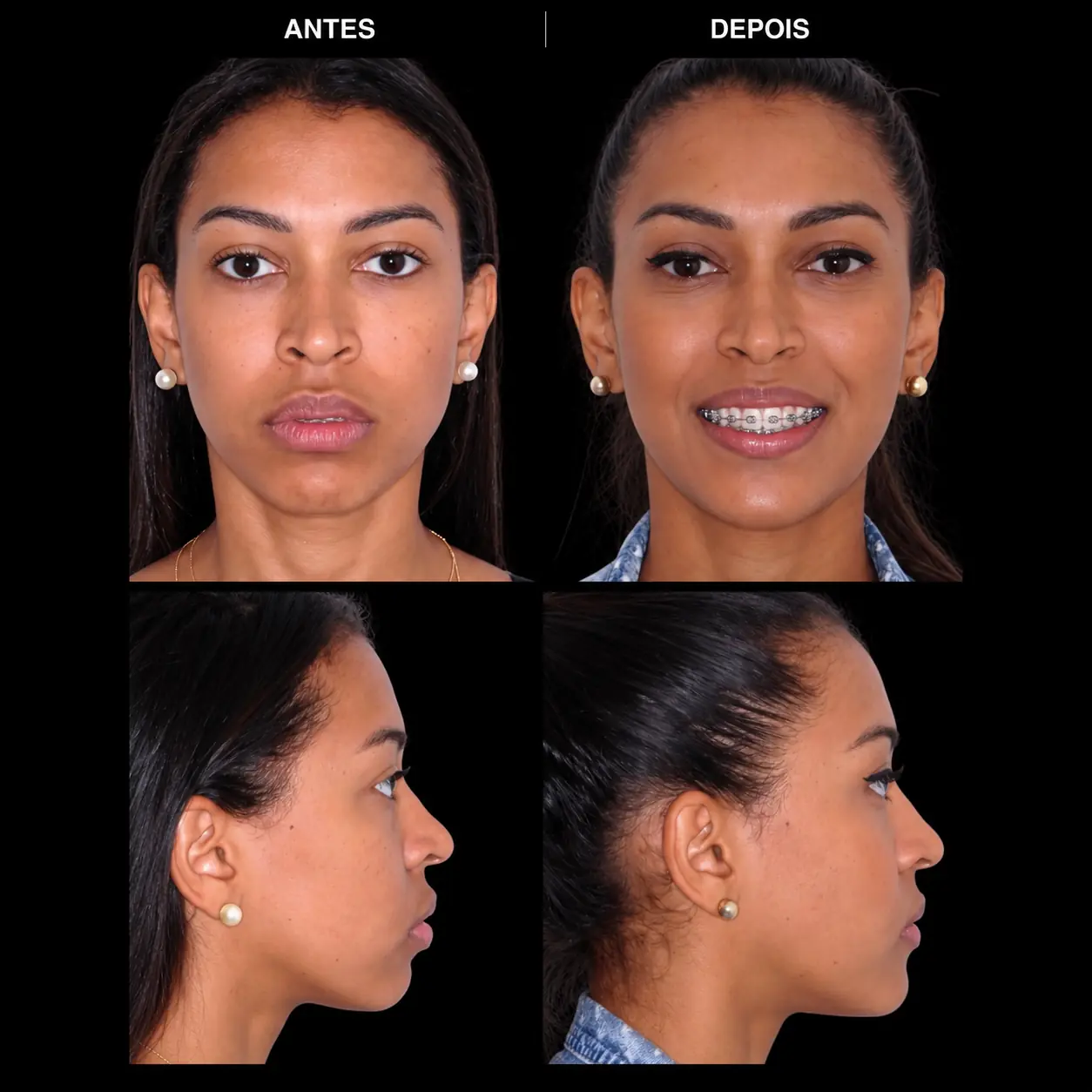 Antes e depois de cirurgia ortognática no Rio de Janeiro — Correção de mordida aberta e do perfil facial. Fotos pré e pós-operatórias de paciente do Dr. Guilherme Lima, cirurgião bucomaxilofacial.