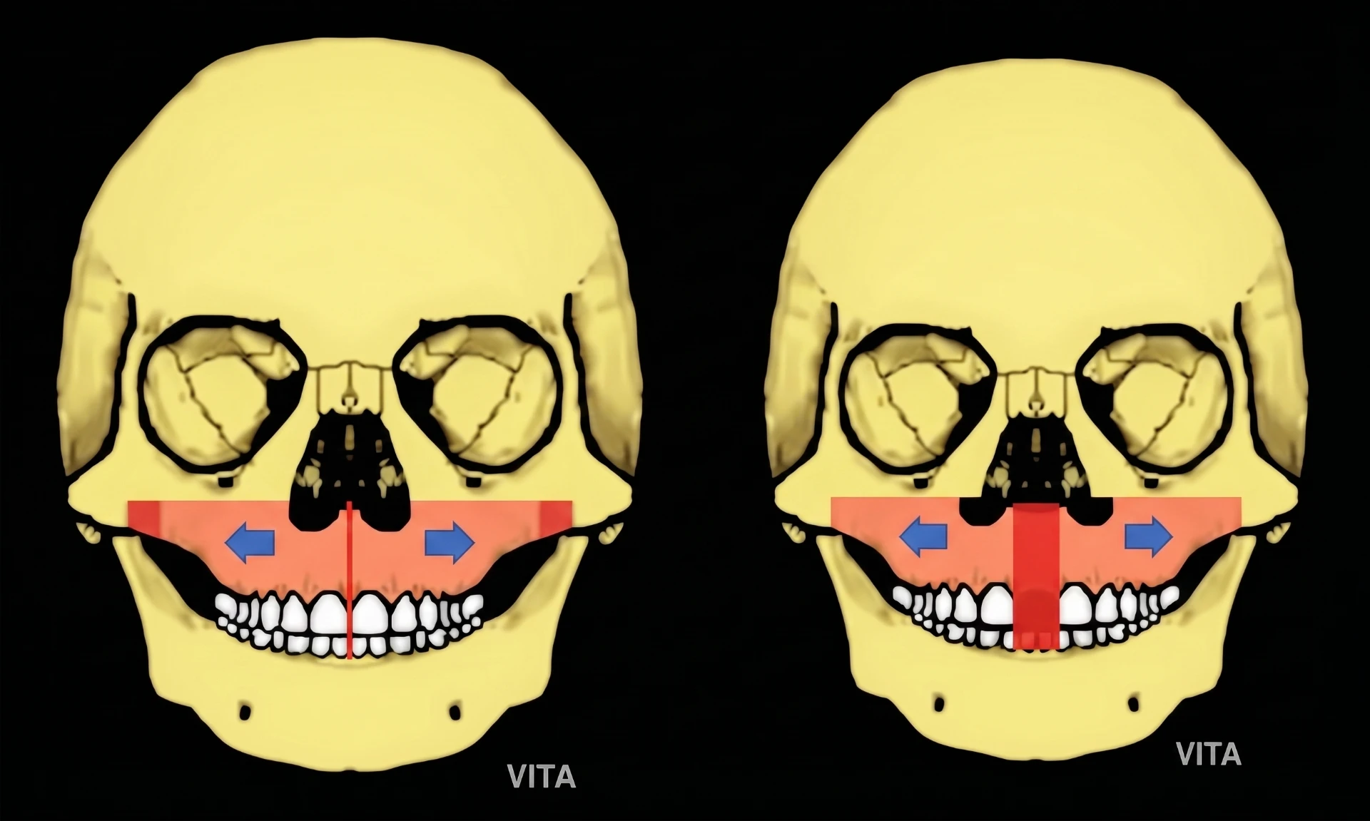 Esquema comparando a expansão maxilar com abertura da sutura palatina mediana em linha única e a expansão com afastamento maior entre as duas hemimaxilas, com setas indicando o vetor transversal