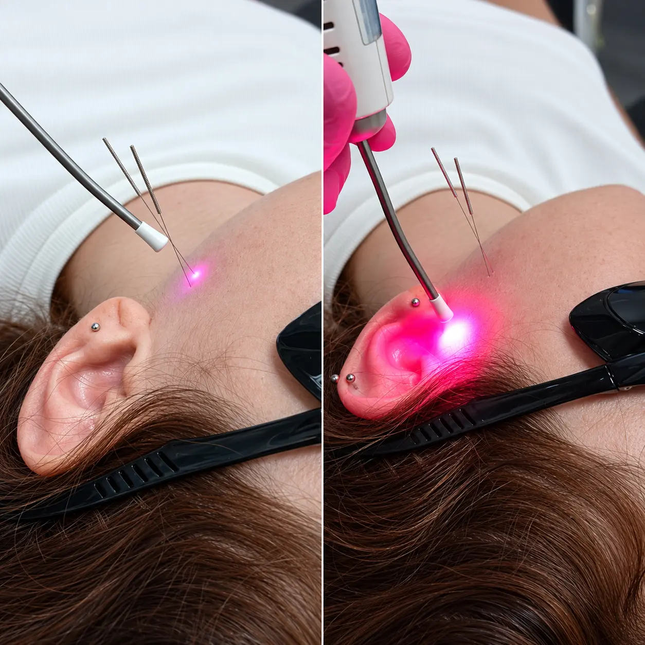 Laserterapia e agulhamento seco em pontos-gatilho