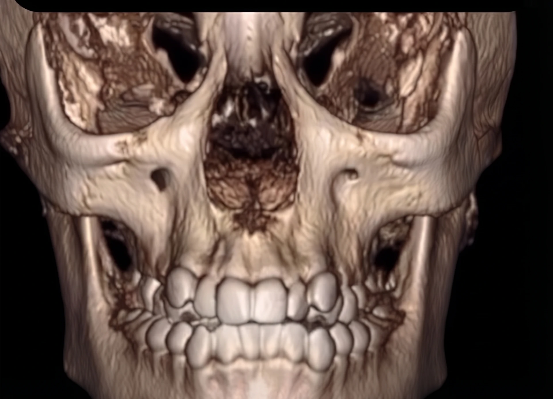 Reconstrução de tomografia 3D em vista frontal após expansão da maxila, com arcada superior mais ampla, cavidades nasais mais espaçosas e oclusão transversal corrigida
