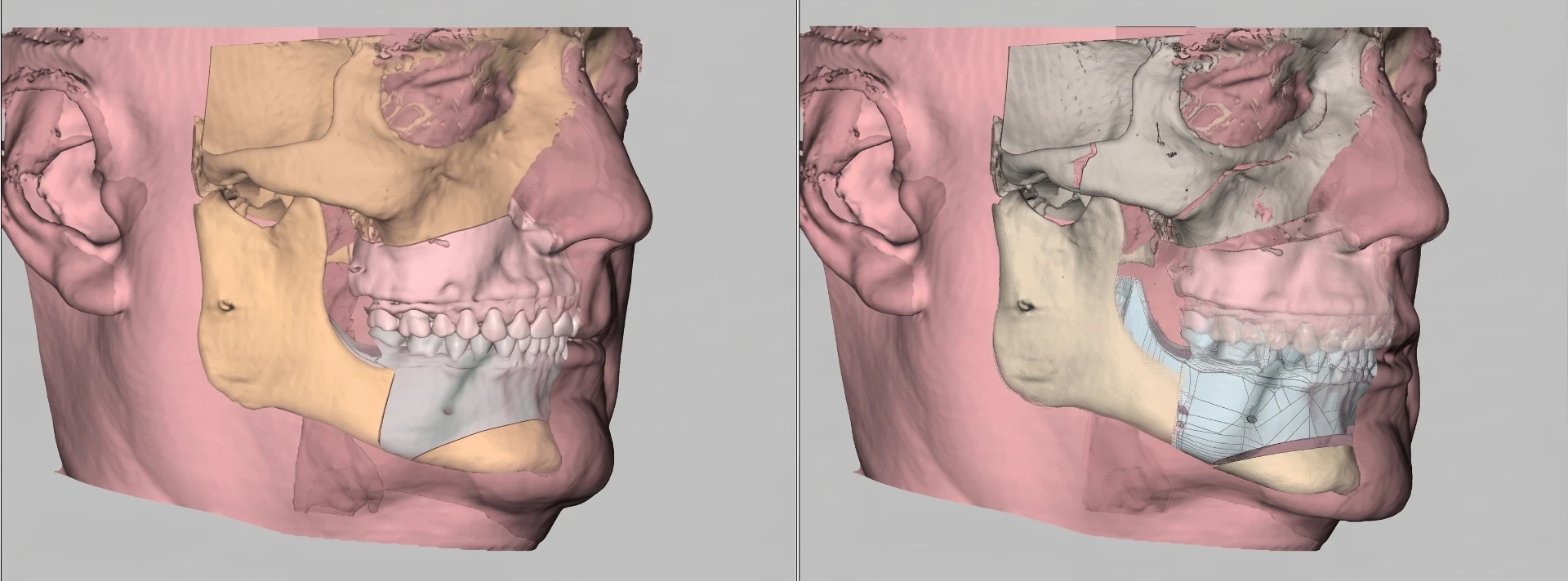 Comparação do planejamento virtual 3D em cirurgia ortognática: modelo digital pré-operatório à esquerda e simulação do reposicionamento ósseo à direita