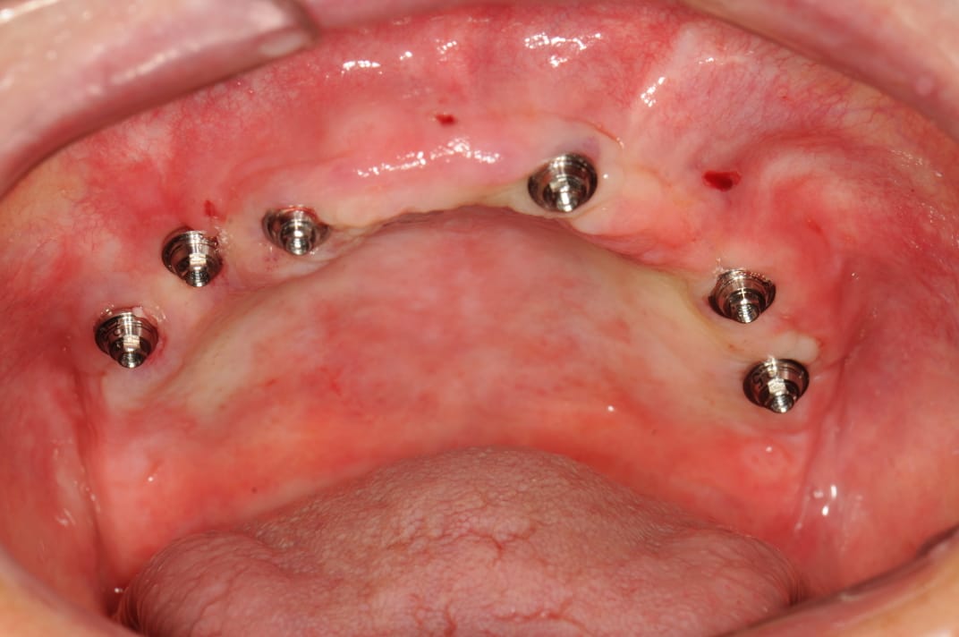 Pilares protéticos instalados sobre implantes no maxilar