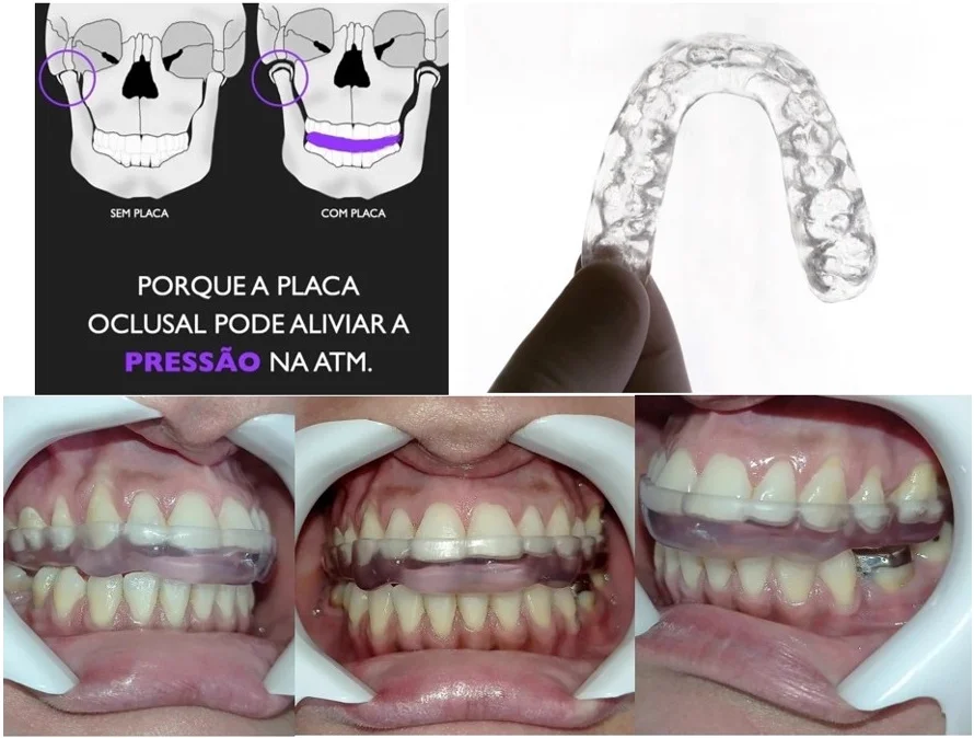Ilustração do crânio sem placa e com placa oclusal, mostrando menor pressão na ATM, ao lado de uma placa transparente e de fotos da placa em uso