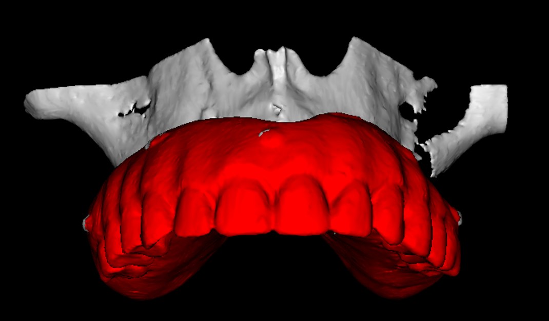 Prótese virtual sobreposta à reconstrução 3D da tomografia do maxilar