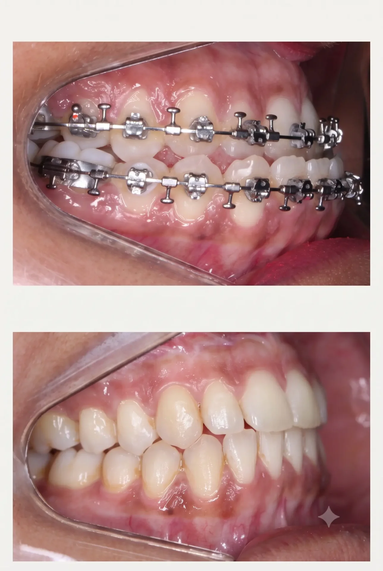 Caso clínico Classe III — registro intraoral pré e pós cirurgia ortognática, evidenciando a correção da mordida.