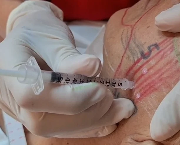 Aplicação de toxina botulínica no músculo masseter com seringa de agulha fina