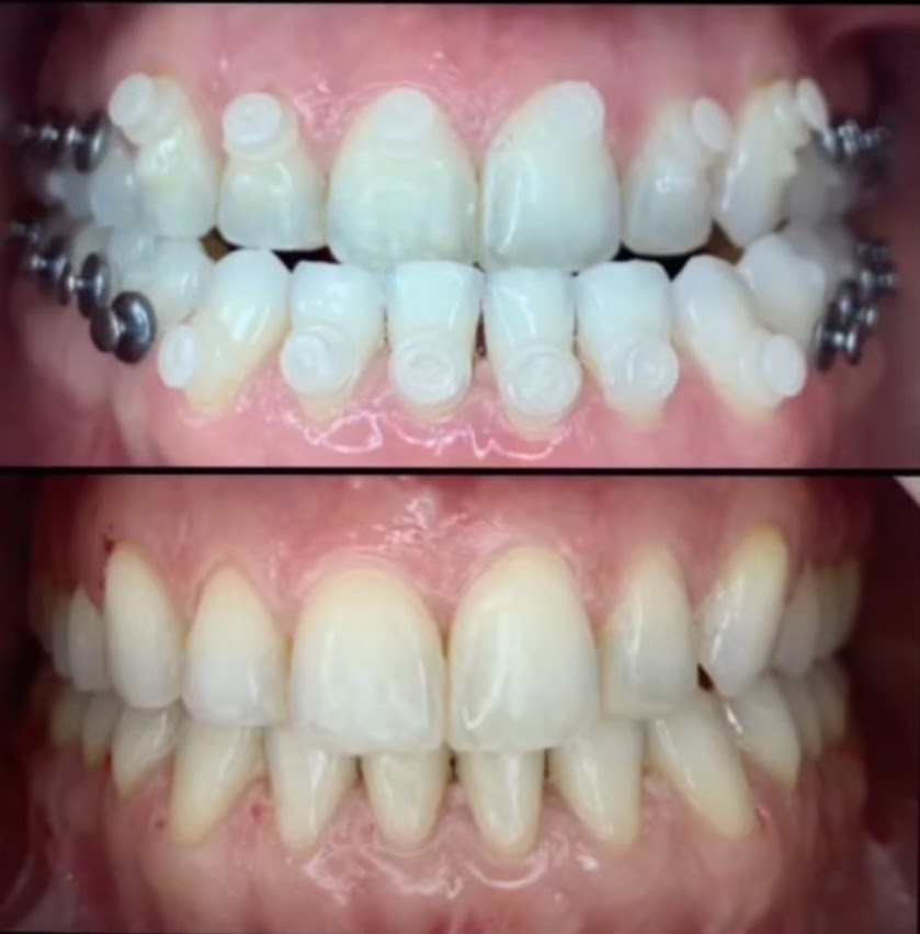 Acima, dentes com attachments de alinhador e parafusos de fixação; abaixo, a mesma arcada após a remoção dos acessórios
