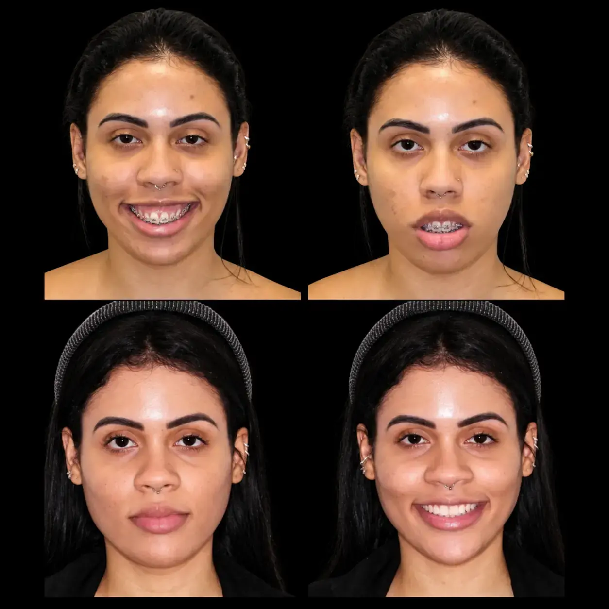 Registro fotográfico pré e pós-operatório de paciente com sorriso gengival por excesso vertical de maxila