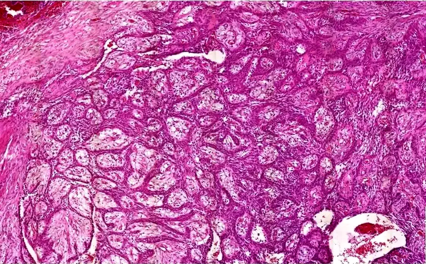 Lâmina histológica corada em hematoxilina e eosina com ilhas de epitélio odontogênico, de biópsia com diagnóstico de ameloblastoma