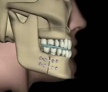 Animação 3D da correção cirúrgica da Classe III
