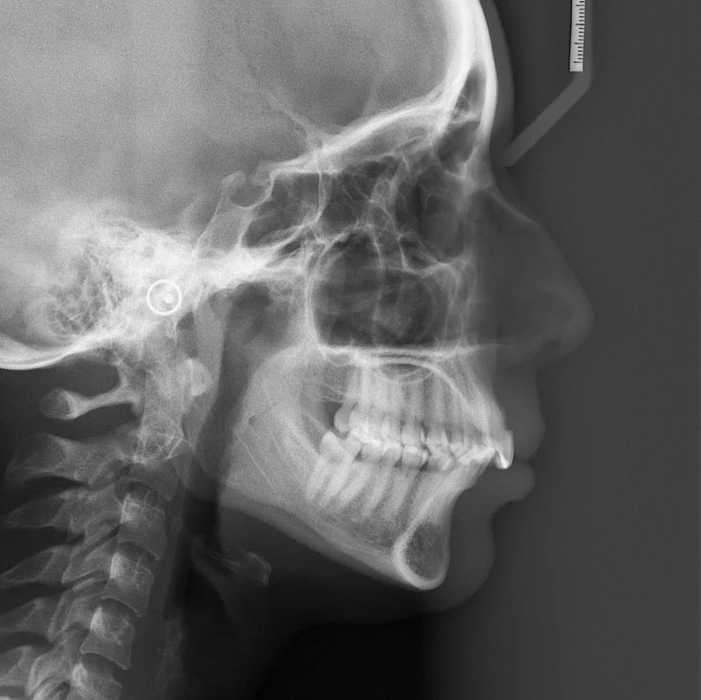 Telerradiografia lateral pré-operatória de mentoplastia, com marcações cefalométricas do terço inferior da face