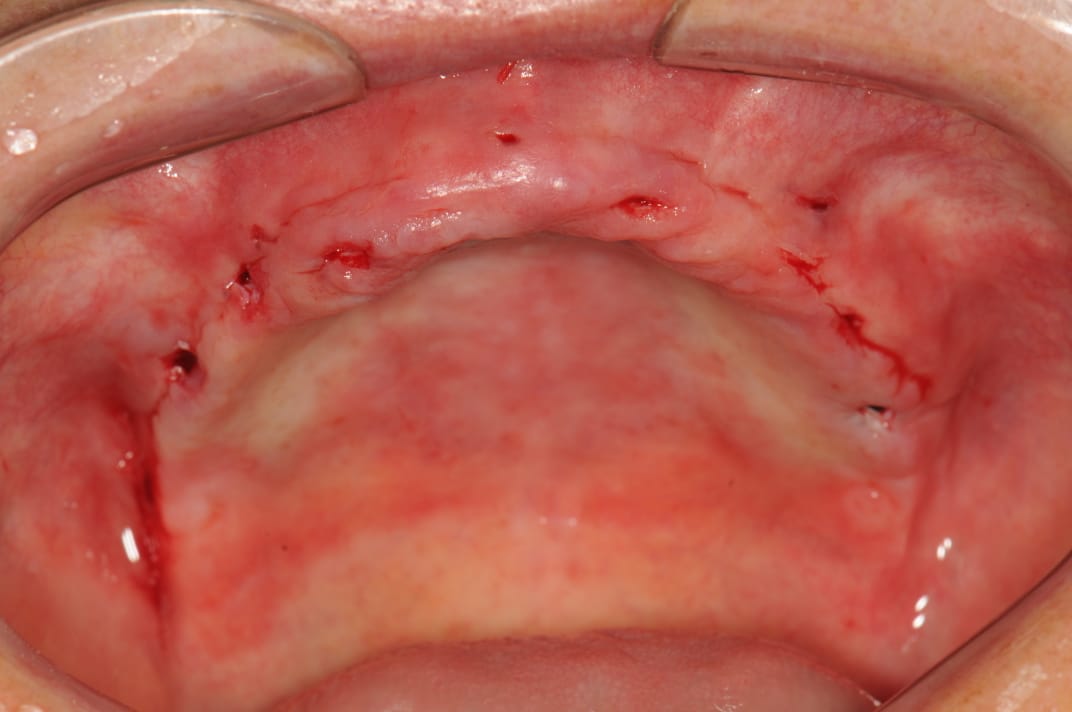 Gengiva logo após cirurgia guiada sem grandes aberturas