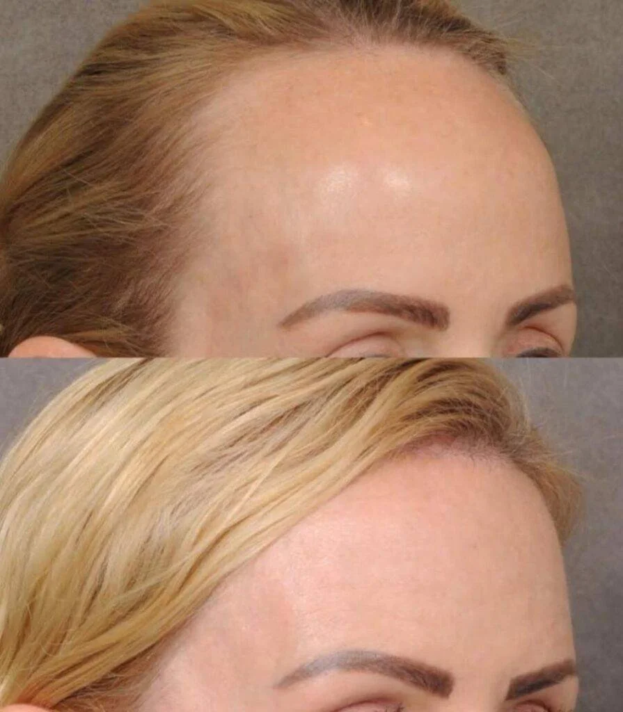 Vista oblíqua da testa antes e depois da frontoplastia com avanço da linha do cabelo