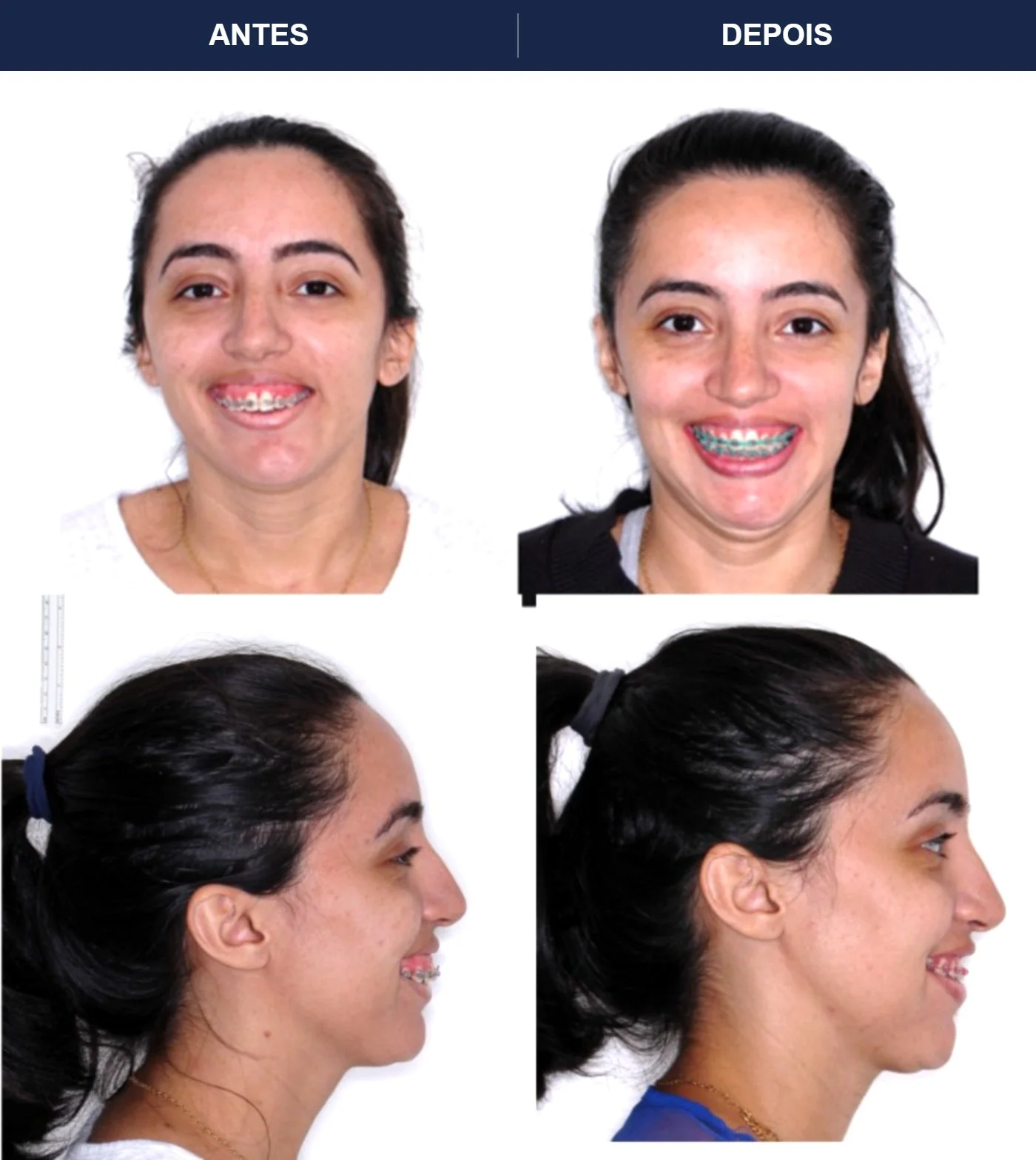 Caso clínico de cirurgia ortognática — Correção de mordida aberta e do perfil facial. Imagens pré e pós-operatórias.