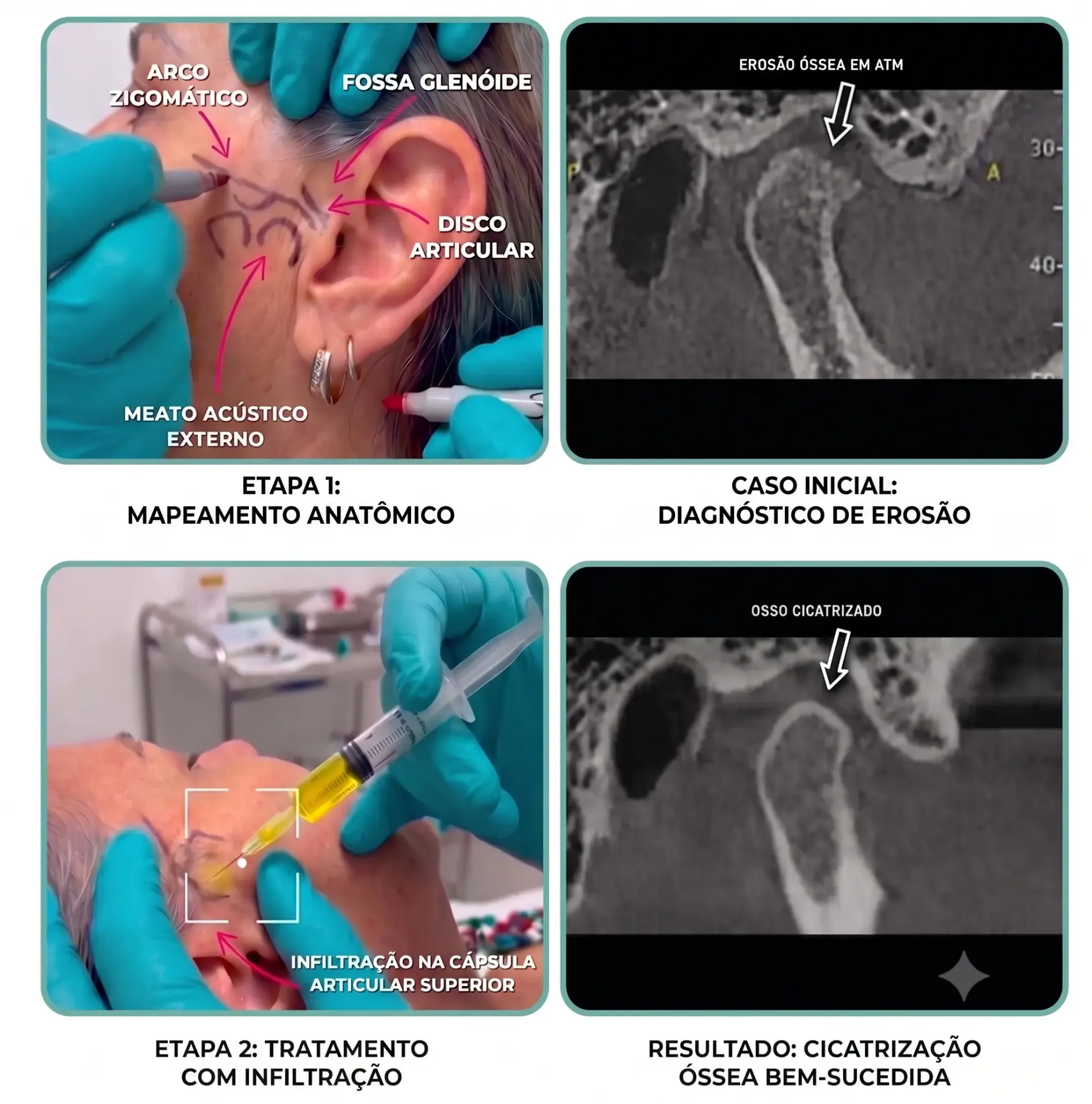 Procedimento de bioestimulação intra-articular com concentrado plaquetário na ATM