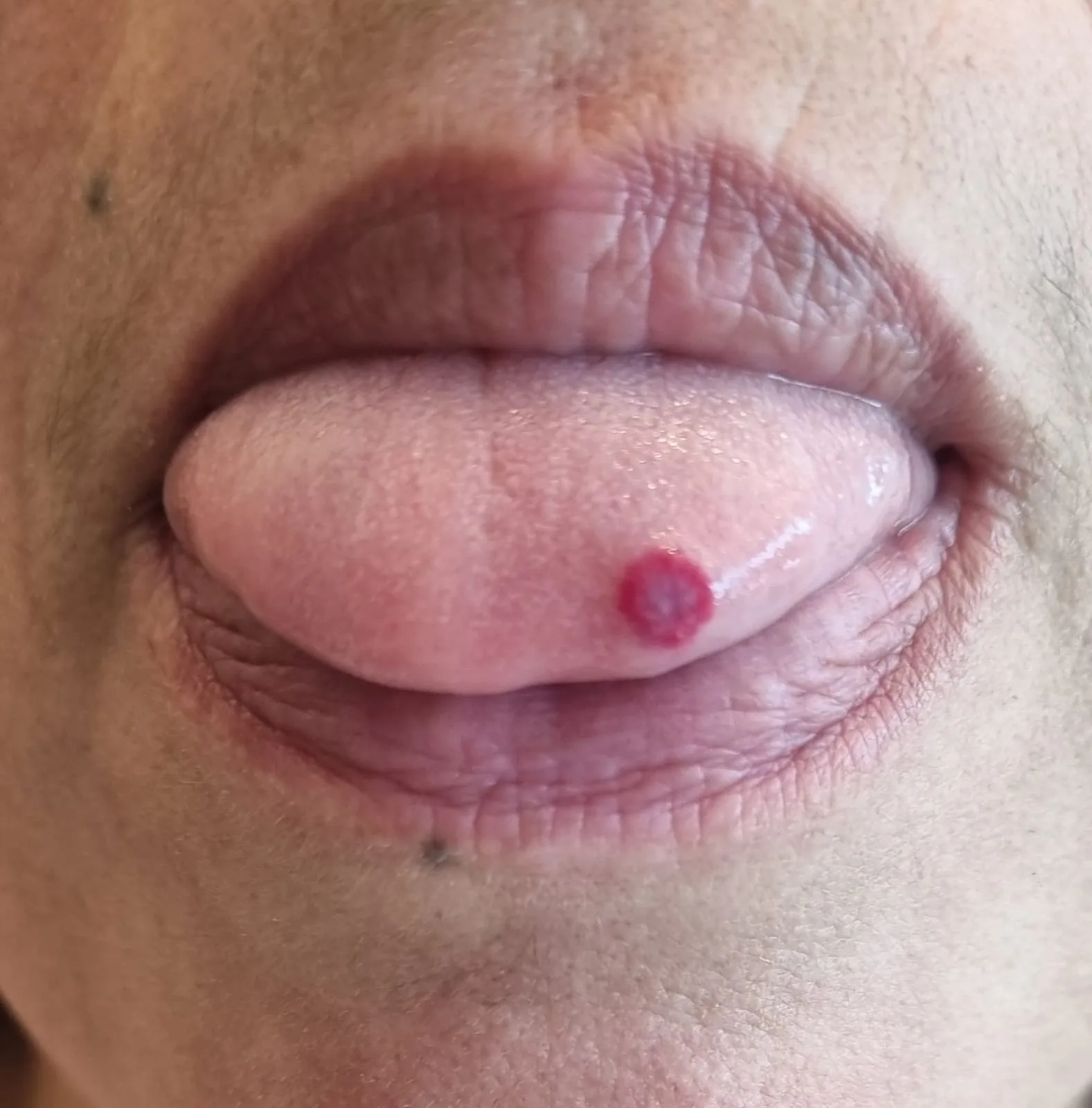 Lesão vascular avermelhada e arredondada na ponta da língua