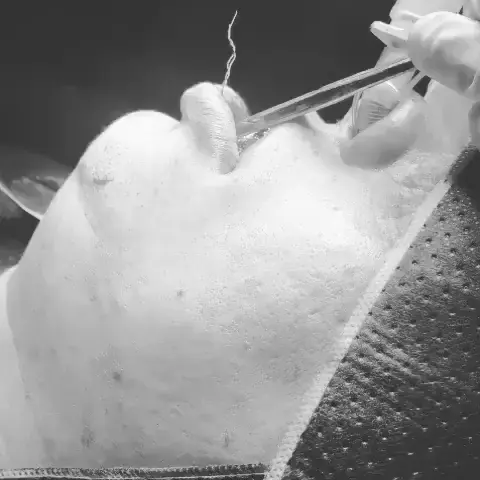 Registro transoperatório de mentoplastia, com exposição controlada do mento por acesso intraoral