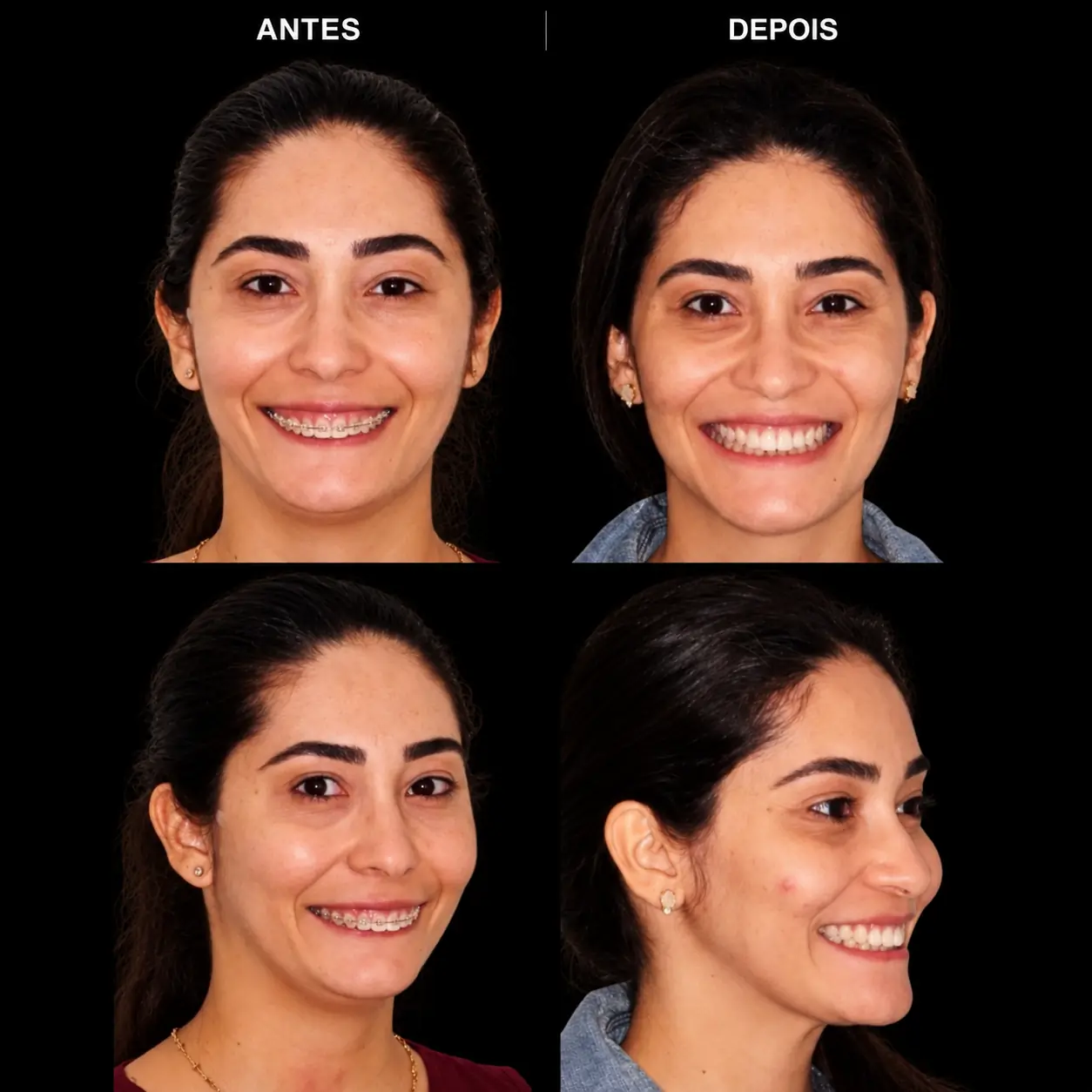 Antes e depois de cirurgia ortognática no Rio de Janeiro — Correção de Classe II — vistas frontal e perfil. Fotos pré e pós-operatórias de paciente do Dr. Guilherme Lima, cirurgião bucomaxilofacial.