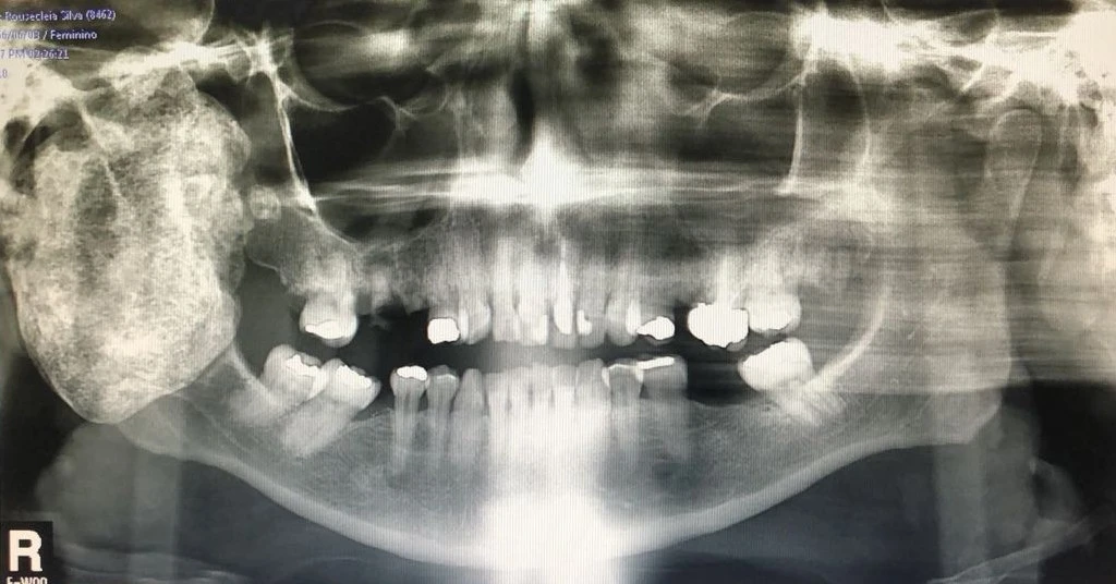Radiografia panorâmica com alteração óssea extensa na face