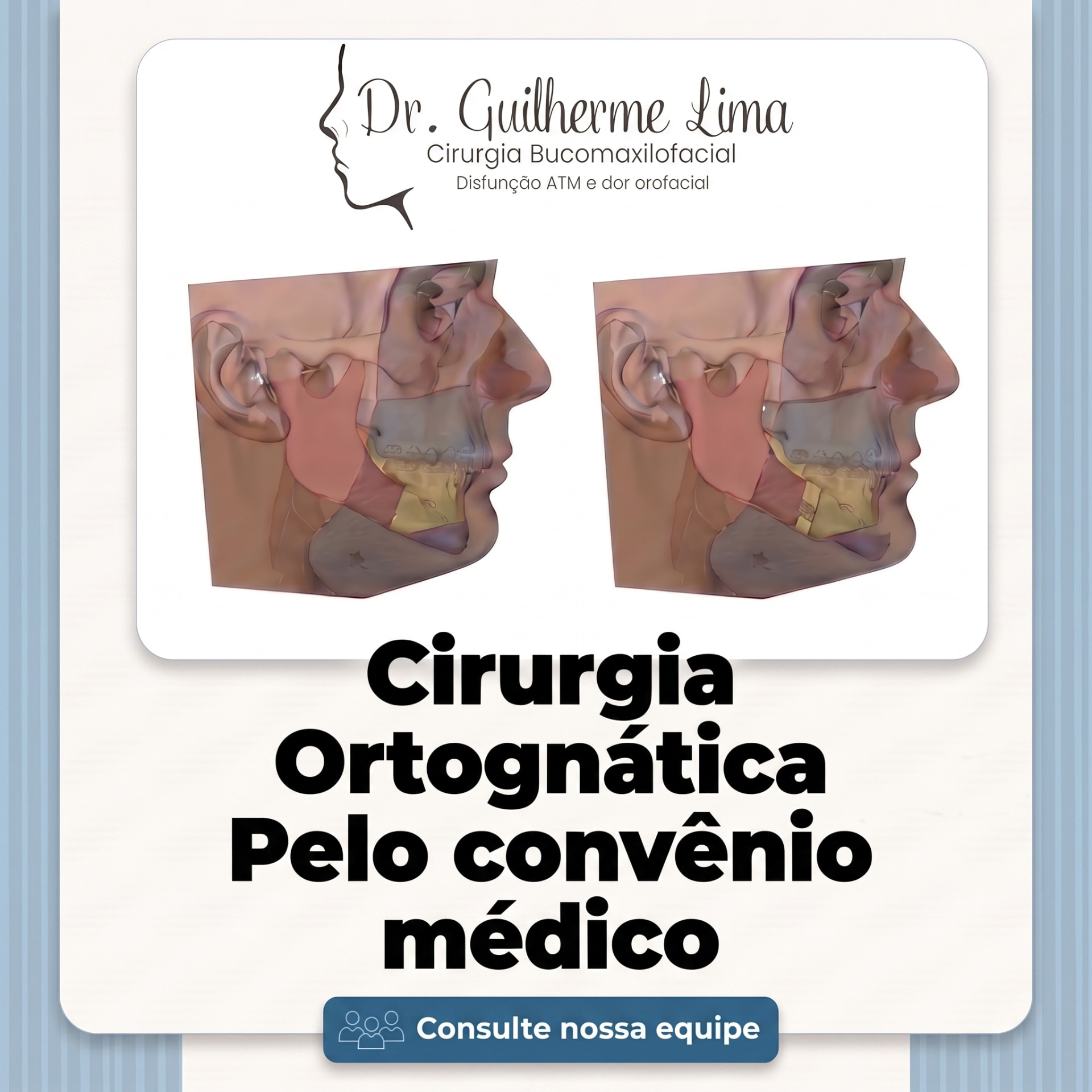 Ilustração de perfil facial antes e depois da cirurgia ortognática — cirurgia ortognática pelo convênio médico