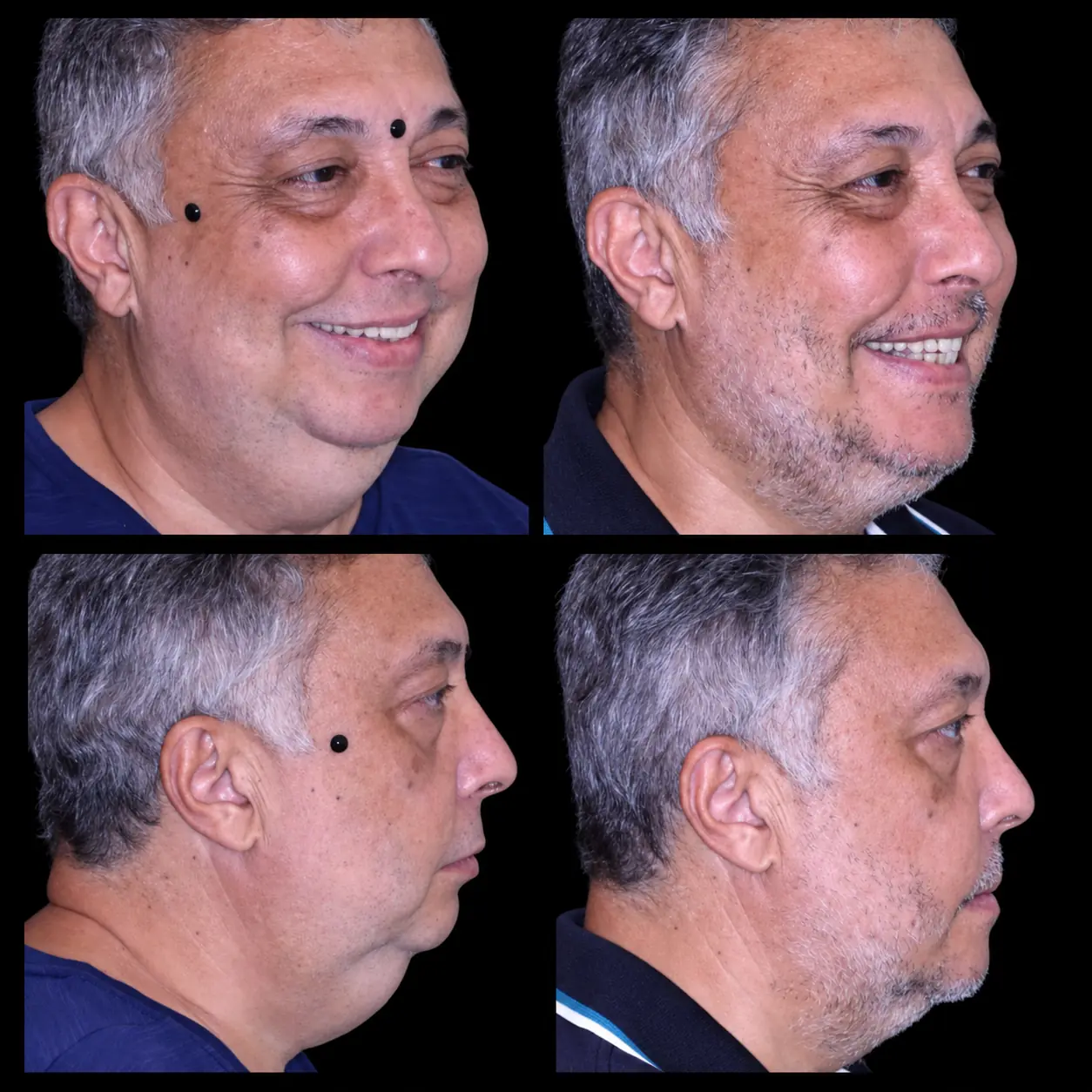 Caso clínico: perfil facial antes e depois da cirurgia ortognática, mostrando reposicionamento da maxila e mandíbula