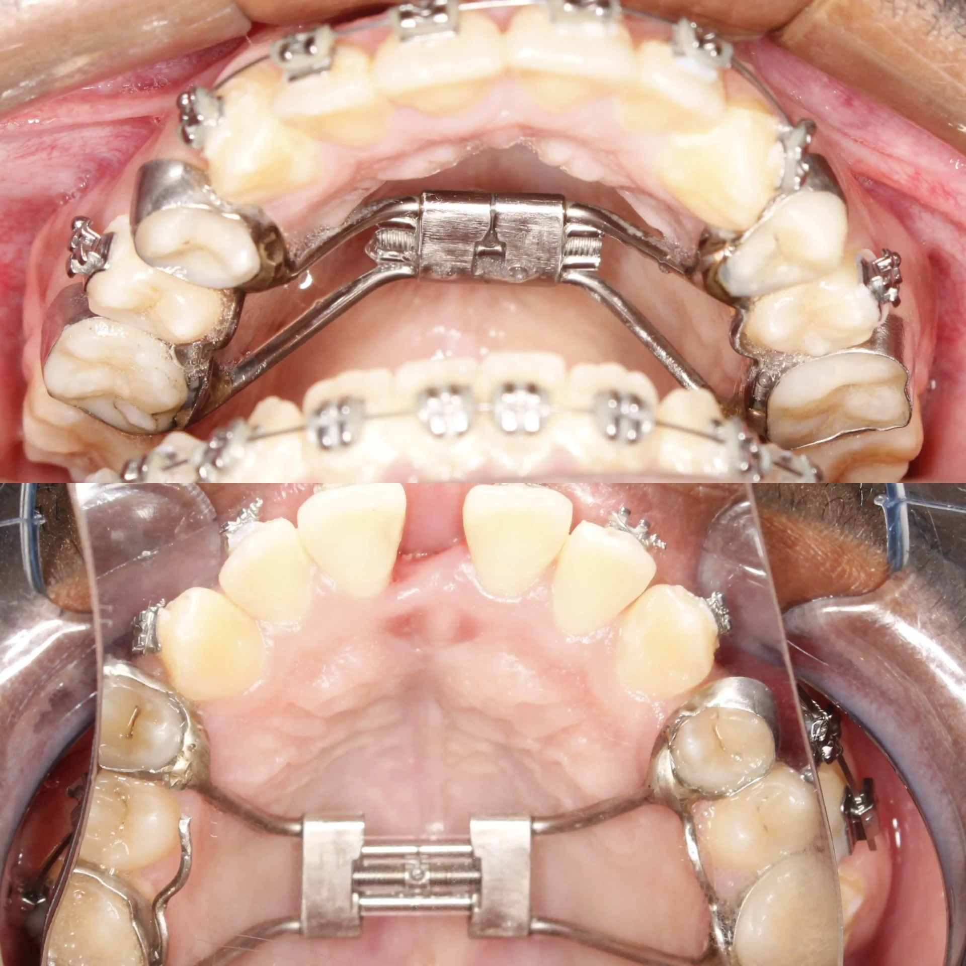 Vista intraoral de paciente adulto com disjuntor Hyrax: acima, o aparelho instalado; abaixo, a abertura do diastema entre os incisivos centrais superiores após a expansão